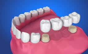 How Much Do Dental Bridges Cost
