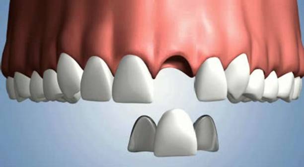 Pros and cons of Dental Bridges