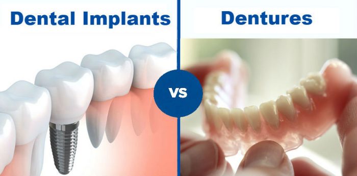 Dental Bridges vs Dental Implants