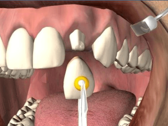 Dental Crowns by Livonia Dentist