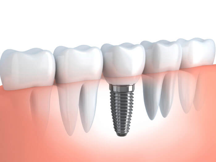 Dental implants in Livonia Michigan
