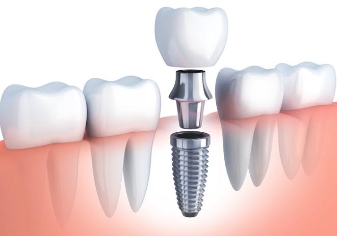 How Long Do Dental Implants Last